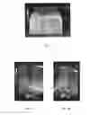 Fig. 04 - Ultrasonically detectable intrauterine system and a method for enhancing ultrasound detection