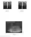 Fig. 06 - Ultrasonically detectable intrauterine system and a method for enhancing ultrasound detection
