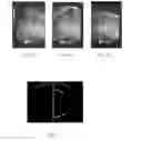 Fig. 08 - Ultrasonically detectable intrauterine system and a method for enhancing ultrasound detection