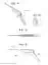 Fig. 02 - Tympanic membrane pressure equalization tube delivery system