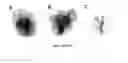Fig. 11 - CONVERSION OF CARDIOMYOCYTES INTO FAST CONDUCTING CARDIOMYOCYTES OR SLOW CONDUCTING NODAL CELLS