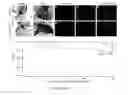 Fig. 12 - CONVERSION OF CARDIOMYOCYTES INTO FAST CONDUCTING CARDIOMYOCYTES OR SLOW CONDUCTING NODAL CELLS
