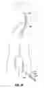 Fig. 06 - Aspiration system for thrombectomy procedures