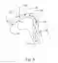 Fig. 07 - Endotracheal Tube Insertion Device