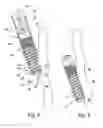 Fig. 03 - Intracardiac capsule implantable on a thin wall, including the septum wall