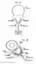 Fig. 09 - Implantable device migration control