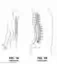 Fig. 02 - Delivery devices, systems and methods for stimulating nerve tissue on multiple spinal levels