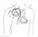 Fig. 01 - Implantable medical device construction