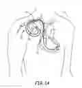 Fig. 02 - Implantable medical device construction