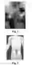 Fig. 02 - Methods of and devices for chemical and threshold-gated electrical neuro-immuno-stimulation that triggers the stem cell growth to restore bodily functions