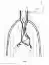 Fig. 02 - METHOD AND DEVICE FOR RESPIRATORY AND CARDIORESPIRATORY SUPPORT