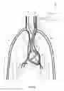 Fig. 03 - METHOD AND DEVICE FOR RESPIRATORY AND CARDIORESPIRATORY SUPPORT