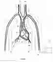 Fig. 05 - METHOD AND DEVICE FOR RESPIRATORY AND CARDIORESPIRATORY SUPPORT