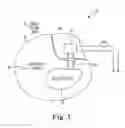 Fig. 02 - Direct integration of feedthrough to implantable medical device housing using a gold alloy