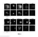 Fig. 03 - Capture, identification and use of a new biomarker of solid tumors in body fluids