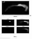 Fig. 04 - Capture, identification and use of a new biomarker of solid tumors in body fluids