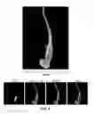 Fig. 07 - Capture, identification and use of a new biomarker of solid tumors in body fluids