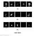 Fig. 10 - Capture, identification and use of a new biomarker of solid tumors in body fluids