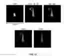 Fig. 24 - Capture, identification and use of a new biomarker of solid tumors in body fluids