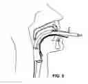 Fig. 10 - Intubating Airway
