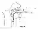 Fig. 16 - Intubating Airway
