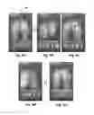 Fig. 15 - SYSTEM AND METHOD OF PRESSURE MAPPING AND 3-D SUBJECT REPOSITIONING FOR PREVENTING PRESSURE WOUNDS