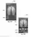 Fig. 16 - SYSTEM AND METHOD OF PRESSURE MAPPING AND 3-D SUBJECT REPOSITIONING FOR PREVENTING PRESSURE WOUNDS