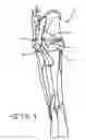 Fig. 02 - Retractor Tool For Minimally Invasive Hip Replacement Surgery