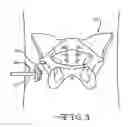Fig. 04 - Retractor Tool For Minimally Invasive Hip Replacement Surgery