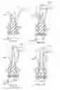 Fig. 04 - Knotless all suture tissue repair
