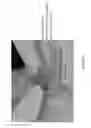 Fig. 74 - Apparatus and methods for fastening tissue layers together with multiple tissue fasteners