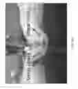 Fig. 85 - Apparatus and methods for fastening tissue layers together with multiple tissue fasteners