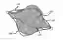 Fig. 01 - Vascular occlusion