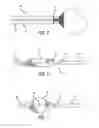 Fig. 04 - Vascular occlusion