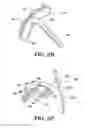 Fig. 06 - Instruments for minimally invasive surgery total knee arthroplasty