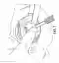 Fig. 19 - Instruments for minimally invasive surgery total knee arthroplasty