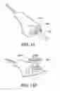 Fig. 22 - Instruments for minimally invasive surgery total knee arthroplasty
