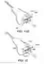 Fig. 23 - Instruments for minimally invasive surgery total knee arthroplasty