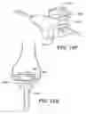 Fig. 24 - Instruments for minimally invasive surgery total knee arthroplasty
