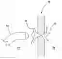 Fig. 01 - Transseptal puncture apparatus and method for using the same