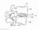Fig. 01 - Spinal fusion devices and systems