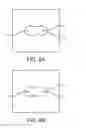 Fig. 09 - Tissue ablation with irreversible electroporation