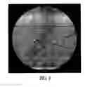 Fig. 04 - Imaging fiducial markers and methods