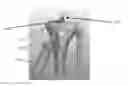 Fig. 01 - Apparatus and method for ligament reconstruction