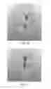 Fig. 32 - Apparatus and method for ligament reconstruction