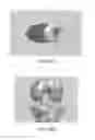 Fig. 45 - Apparatus and method for ligament reconstruction