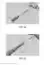 Fig. 47 - Apparatus and method for ligament reconstruction