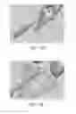 Fig. 67 - Apparatus and method for ligament reconstruction