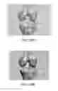 Fig. 71 - Apparatus and method for ligament reconstruction