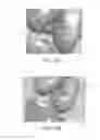Fig. 75 - Apparatus and method for ligament reconstruction